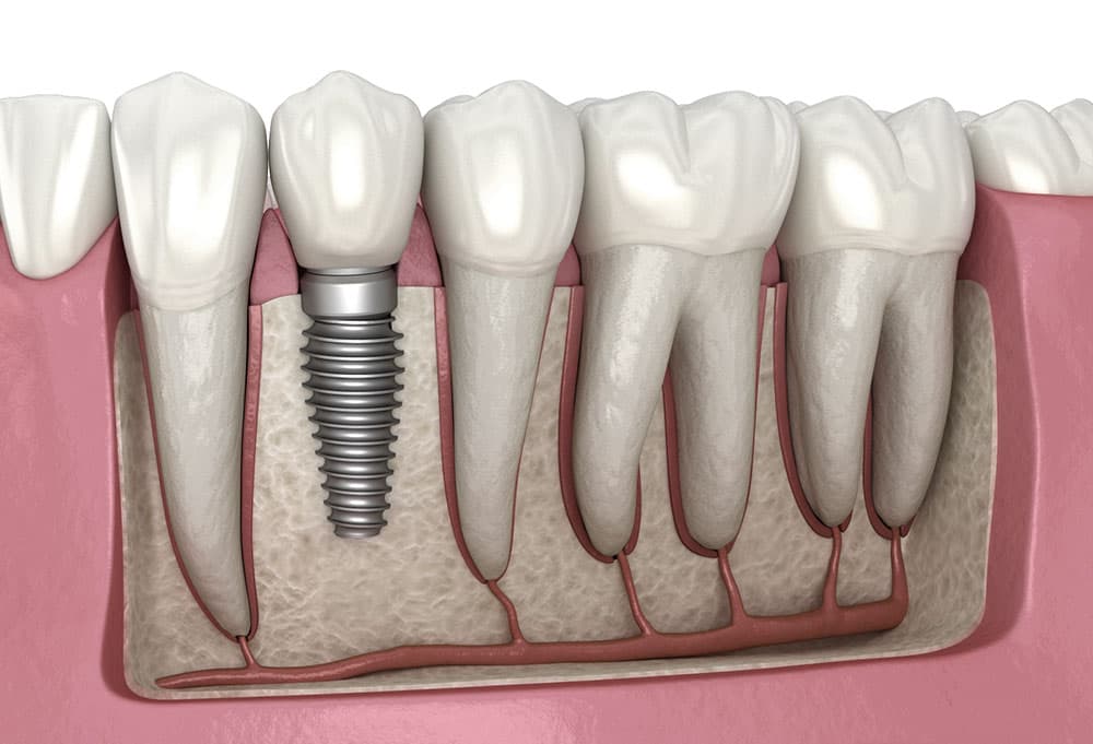 Dental implant placement diagram