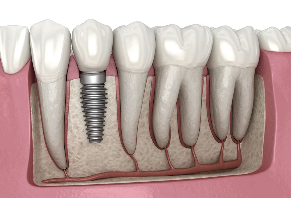 Dental implant placement diagram