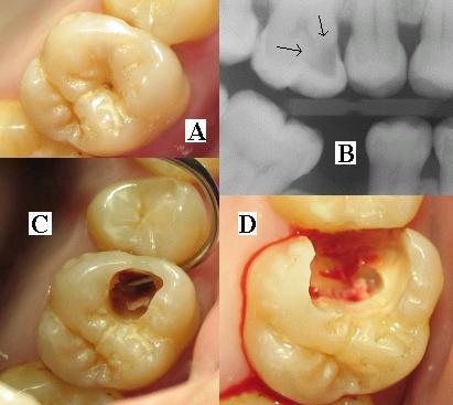 Dental X-ray showing tooth roots
