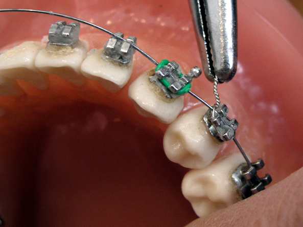 Orthodontic treatment with braces
